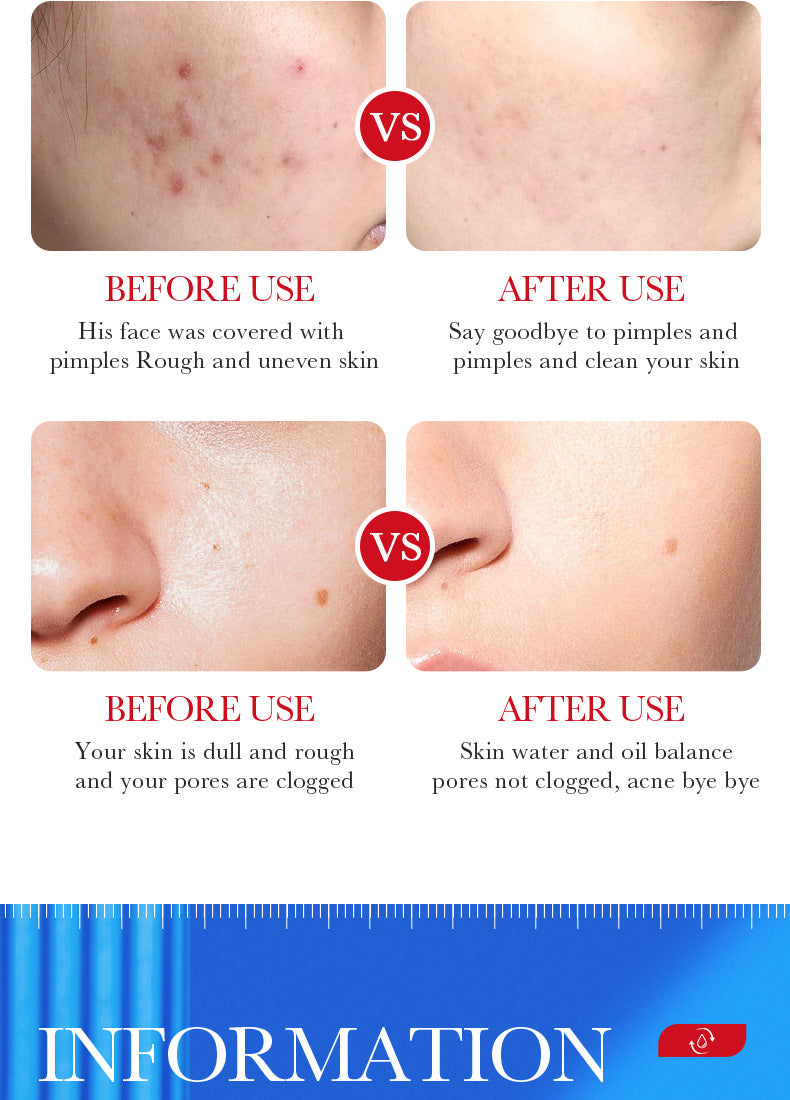 Full English Cream BIOAOUA Salicylic Acid Moisturizing Hydrating Fading Acne Marks  Wholesale